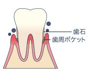 中程度の歯周炎（P2）