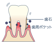 重度の歯周炎（P3）